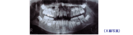 子どもの歯（乳歯）から、おとなの歯（永久歯）に