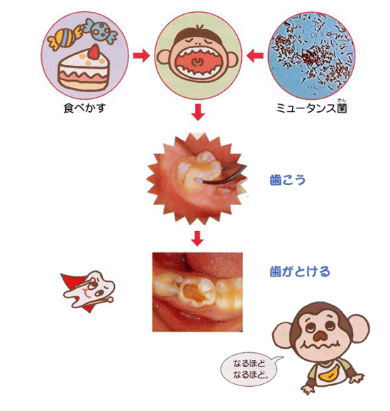 むし歯のできかた