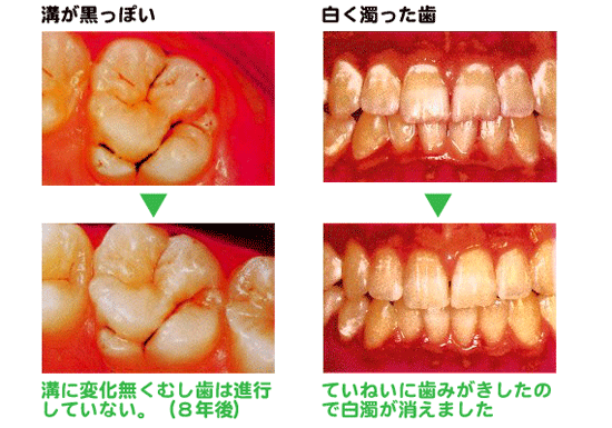 自分ががんばることでむし歯になるのを防げるんだね