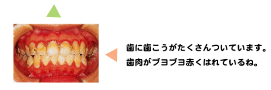 歯肉の健康は、歯こうと関係があるんだ